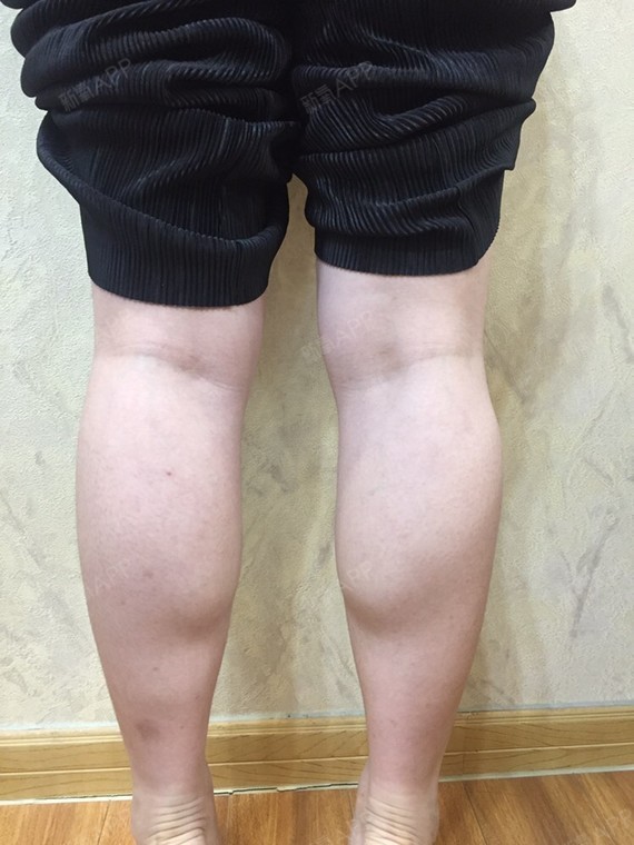 格蕾泰尔肉毒素瘦小腿第0天美丽日记