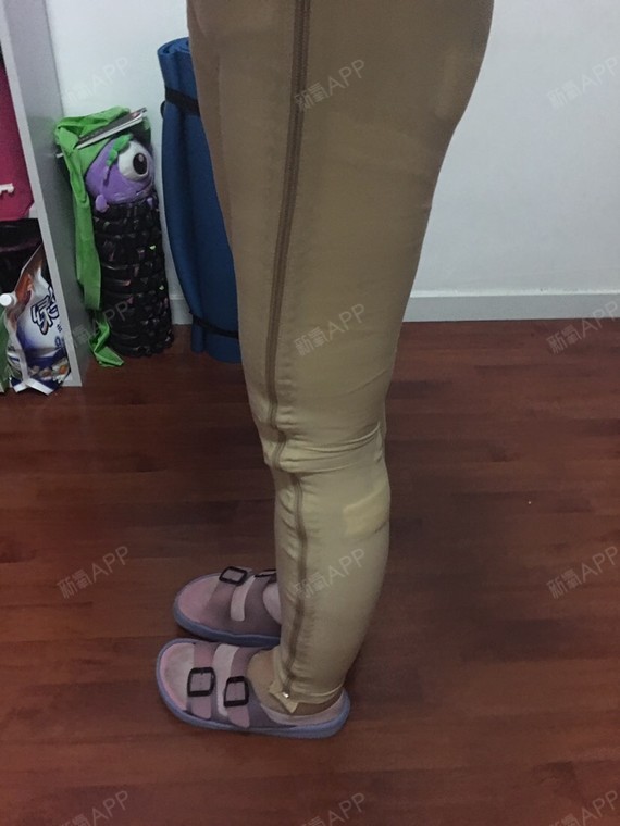 大小腿吸脂自体脂肪填面部术后第七天啦