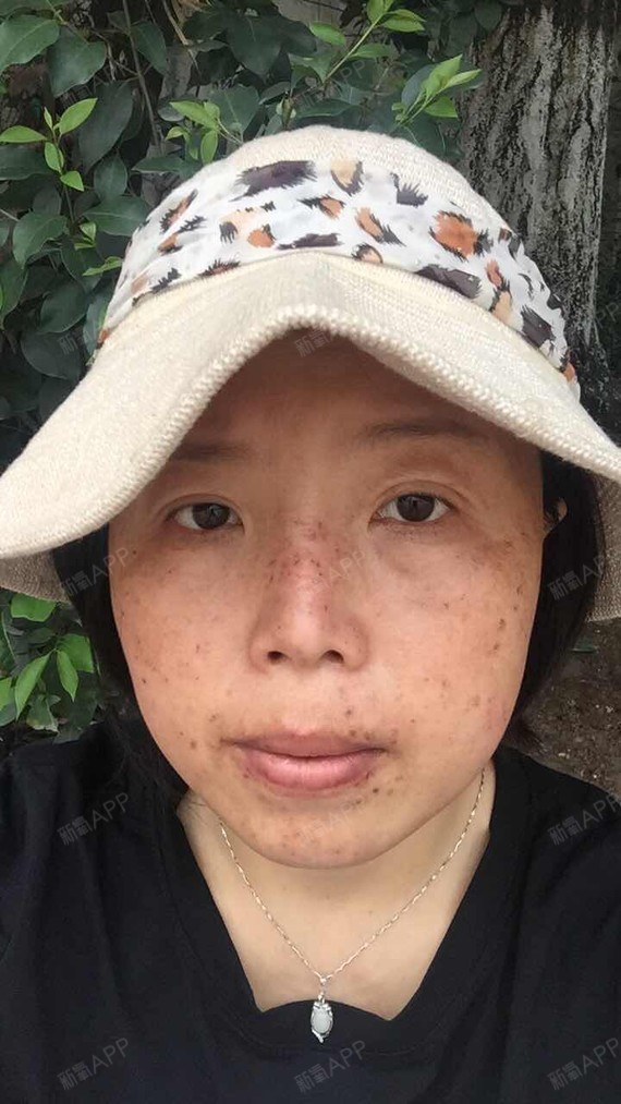 新氧- 吴小夏 | 术后当自强 | 成都同城 | 护肤 | 皮秒激光