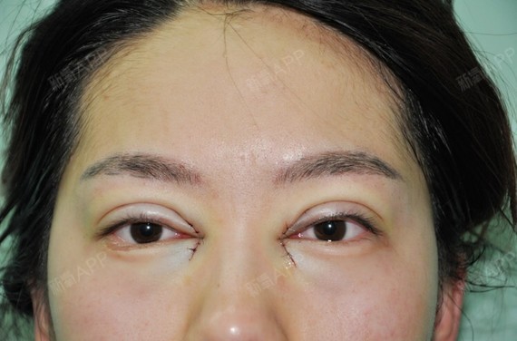 我做了双眼皮和开眼角,眼睛比以前大了好多