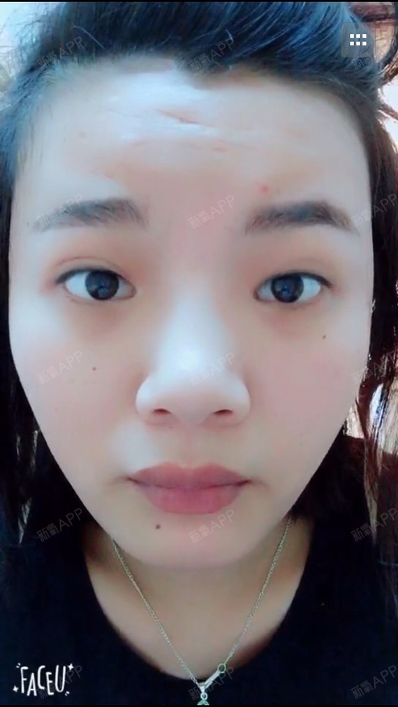额头现在有点凹凸不平会觉得不舒服,我现在都不知道怎_圈子-新氧美容