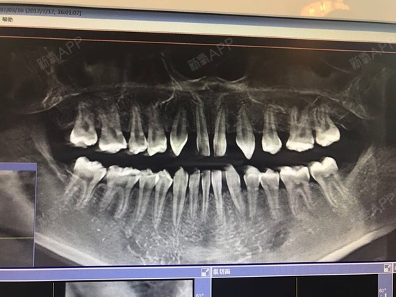 先天性缺失还有牙缝