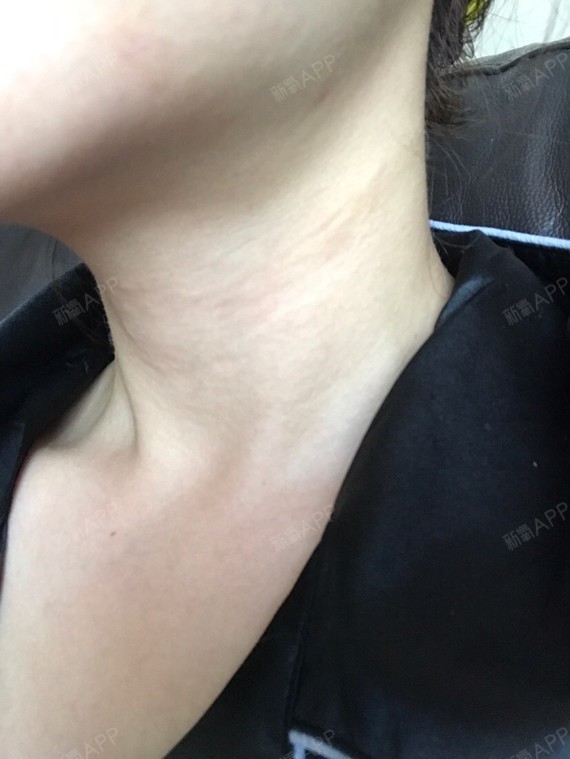 现在的脖子是这样的,侧面有一边依旧有一条小线鼓着,_圈子-新氧美容