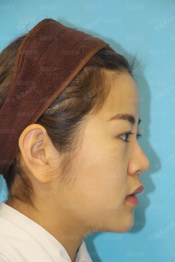 【四川晶肤-线雕隆鼻】本来对自己的外貌并没有太多的要求,看着身边的