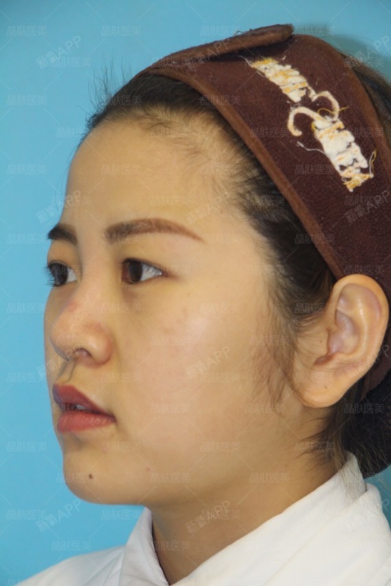 【四川晶肤-线雕隆鼻】本来对自己的外貌并没有太多的要求,看着身边的