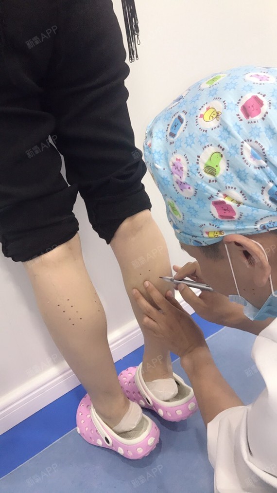 beenle1肉毒素瘦小腿第0天美丽日记