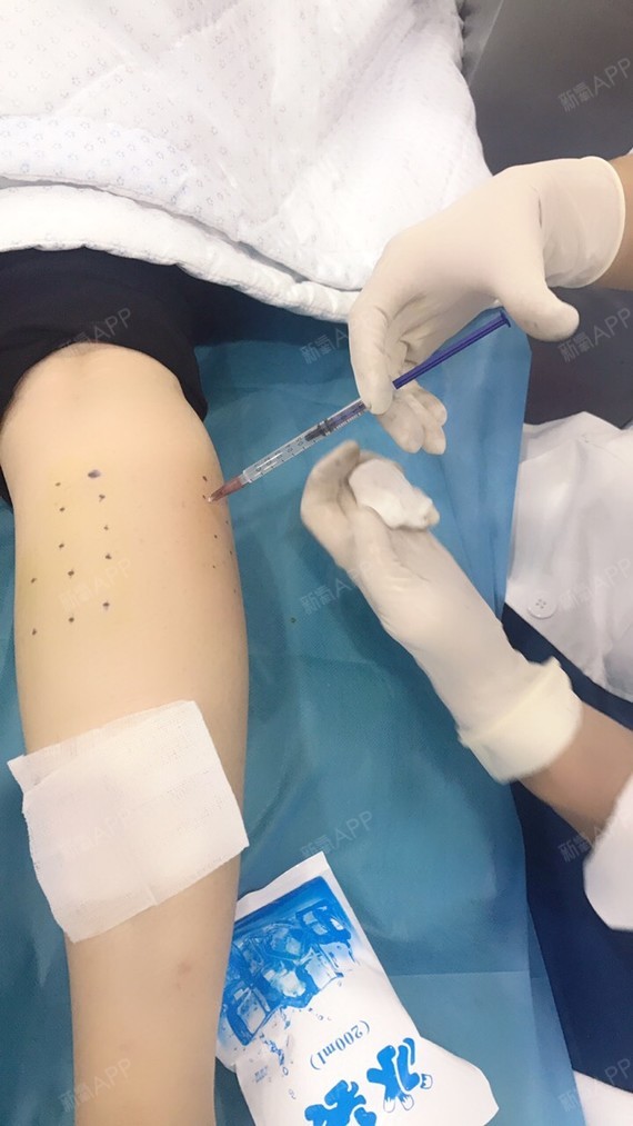 beenle1肉毒素瘦小腿第0天美丽日记