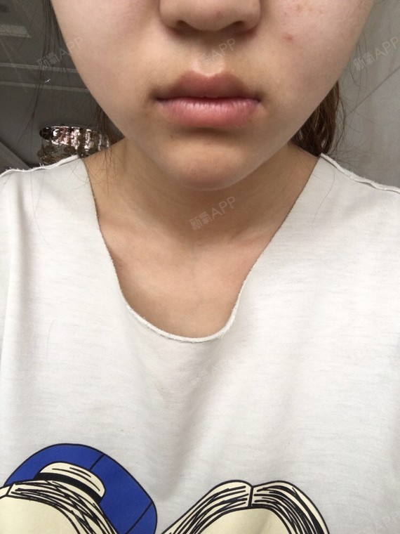 玻尿酸下巴打了一个月了还是有硬块不吸收还越来越长了_圈子-新氧美容