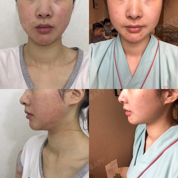 今天已经第30天了,一直忘记要写日记,时间过的挺快_圈子-新氧美容整形