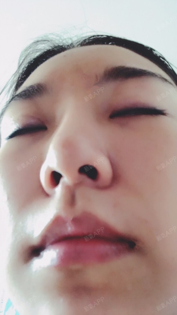 济南硅胶隆鼻好不好_效果图_氧气qkdc6a1硅胶隆鼻术后第64天_新氧美容