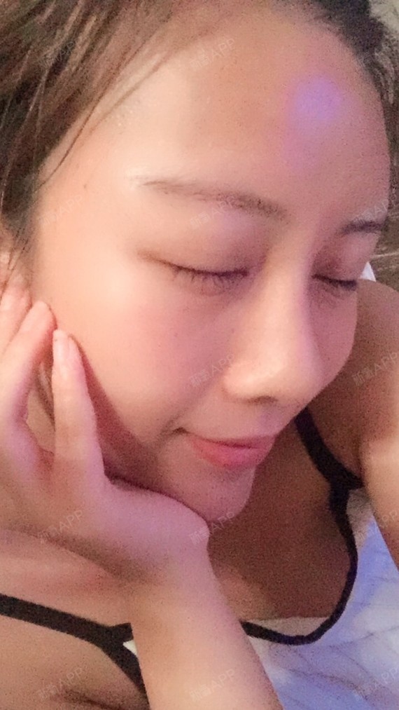 鼻子两个月前做过四根蛋白线 有的医生说会吸收可以直接做假体