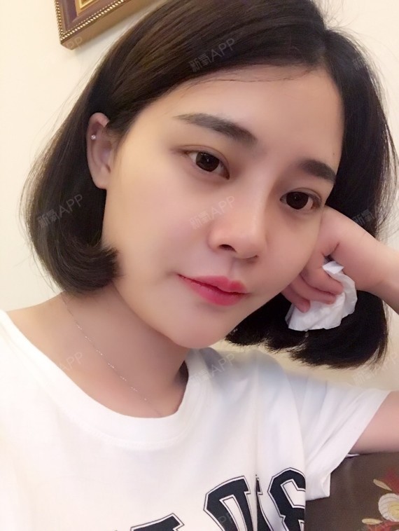 长沙真爱线雕隆鼻术后第15天李瑶今天是做完线雕隆鼻术后半个月了嘻嘻
