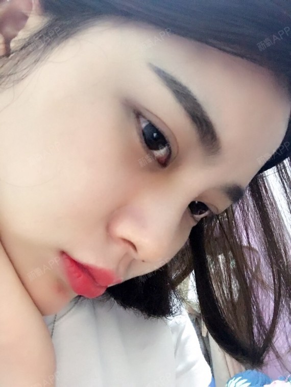 长沙真爱线雕隆鼻术后第15天李瑶今天是做完线雕隆鼻术后半个月了嘻嘻