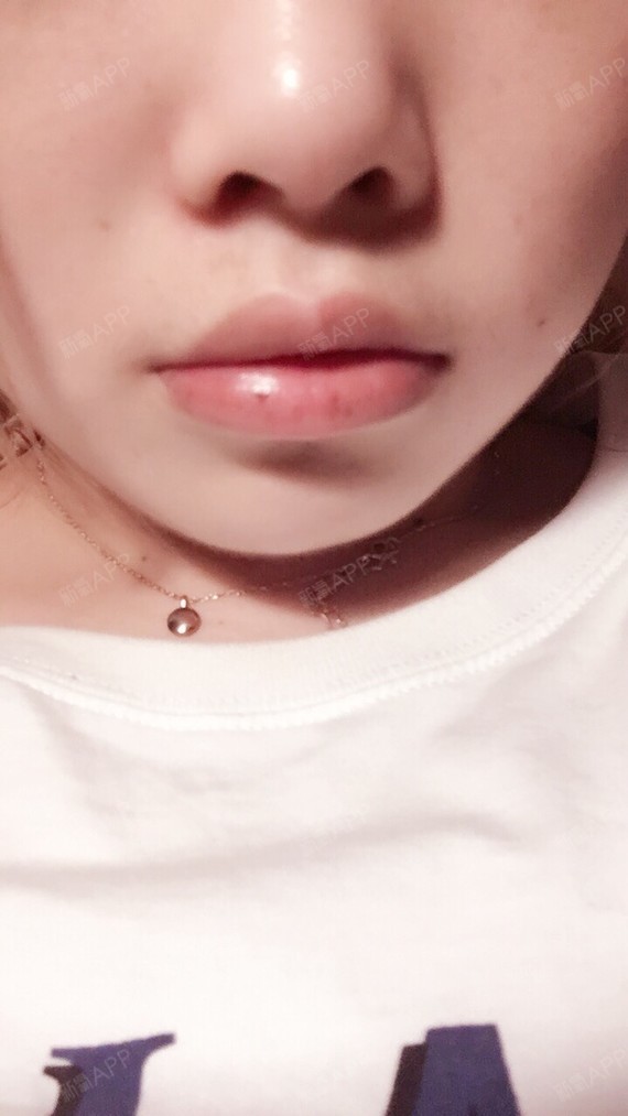 嘴巴比较翘并且厚,尤其下嘴唇厚有点外翻,常被