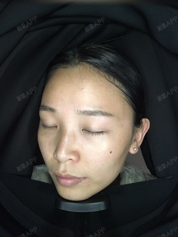 苏州水光针好不好_效果图_不二小琳水光针术后第天_新氧美容整形