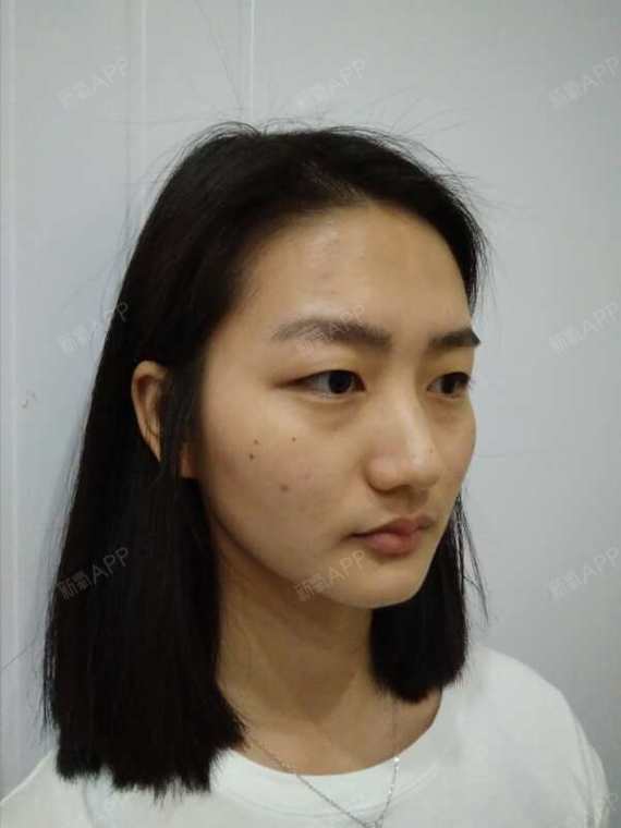 【张鹏全切双眼皮】术后第11天,今天第一次来新氧和_圈子-新氧美容