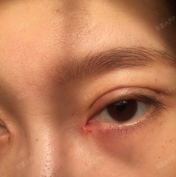 昨天去拆线拆完线舒服多了拆线真的剧痛无比眼角不知道_圈子-新氧美容
