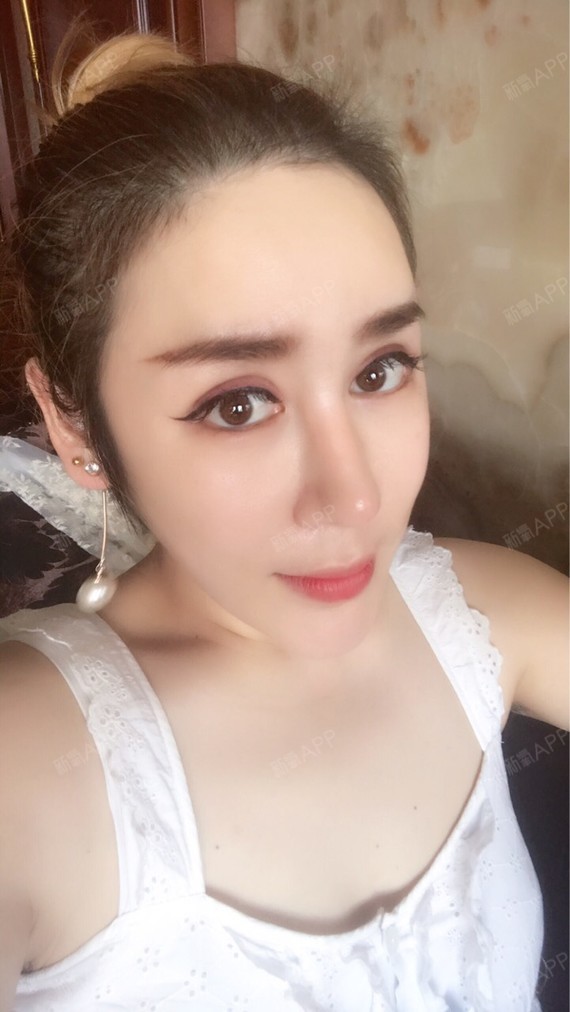 耳软骨复合隆鼻好不好_效果图_大美_523946耳软骨复合隆鼻术后第0天