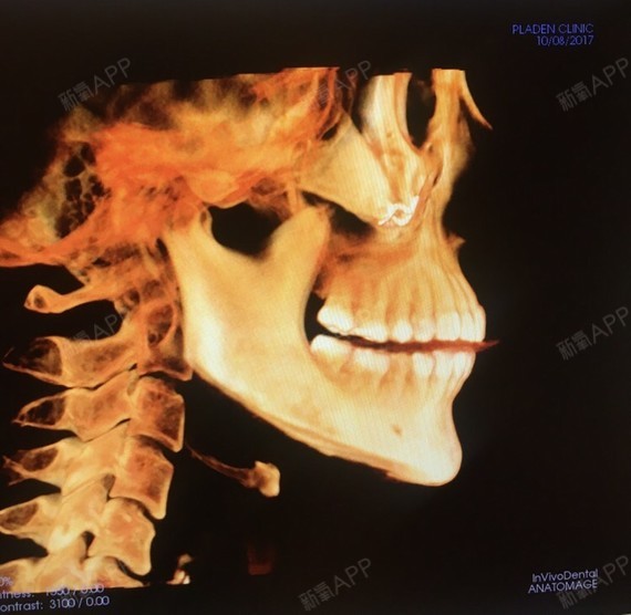 韩国布拉德石润院长 轮廓三件套〗术后ct