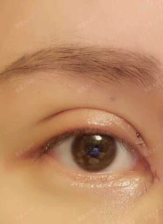 内眼角缝的细,出了瘢痕期不会有什么痕迹.