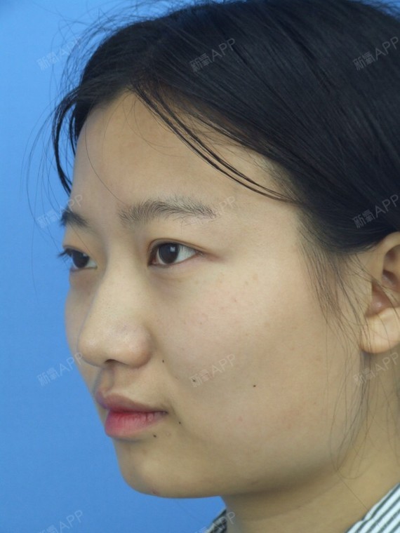 #新疆整形#诗目美眼#现在正值暑期所以我们医