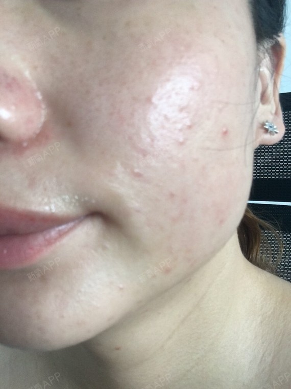 已经做完针清半个月了呢,从开始的做完针清皮肤排毒消炎红肿,脸部战痘