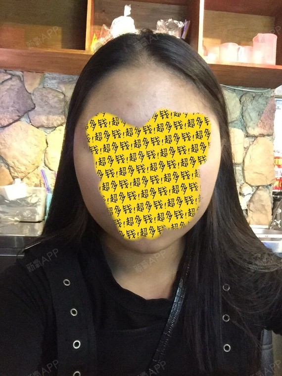 瘦脸针效果持续多久_瘦脸针持续时间_瘦脸针一般持续多久