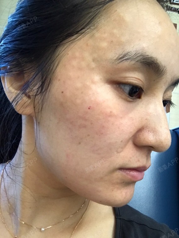 护肤美妆 | 皮肤 | 术后当自强 | 上海同城 | 水光针