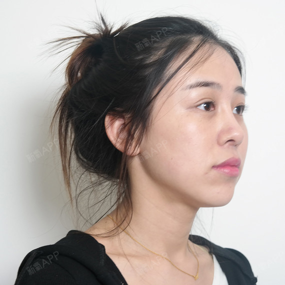 最近照镜子发现下巴饱满了会有像窝一样的出现还是蛮好_圈子-新氧美容