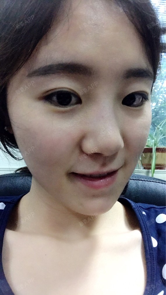 北京水光针好不好_效果图_大路aiym水光针术后第7天_新氧美容整形