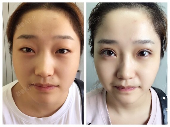 切开双眼皮 提肌术前,术后一周拆线对比,一个双眼皮_圈子-新氧美容