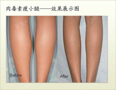 注射botox瘦小腿效果