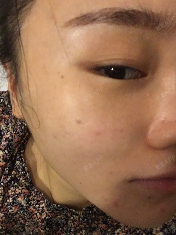 别的地方做得色素沉淀弄淡了好多,现在已经离我做完他家水光针2个月了