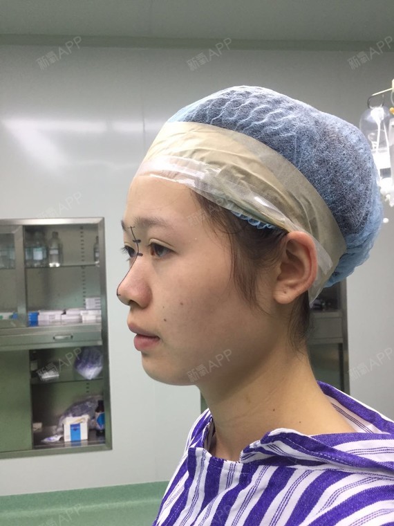 屋里亲故在正好做的异体隆鼻非常成功,瞬间就把我吸引_圈子-新氧美容