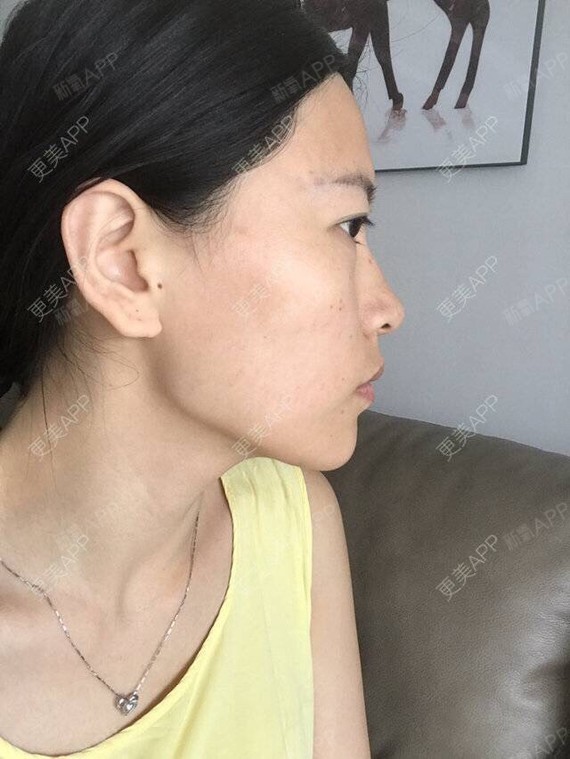 我长期一边咀嚼的原因,有大小脸,也打过几次肉毒素,_圈子-新氧美容