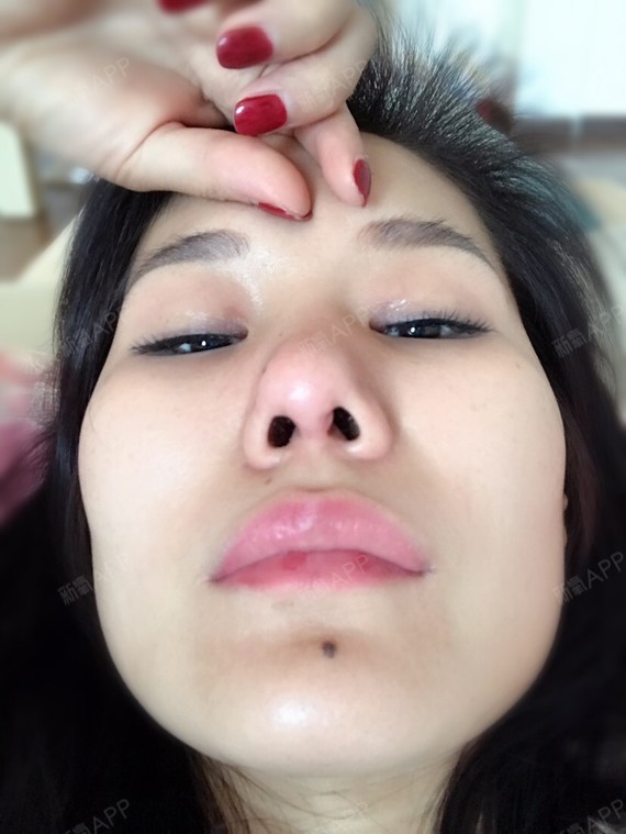 鼻假体取出有九个月了增生还是严重,想问医生我想做修_圈子-新氧美容