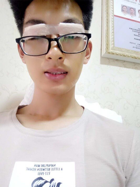 不过这类型的眼睛做双眼皮手术容易使眼睛上吊,所以要配合开眼角.