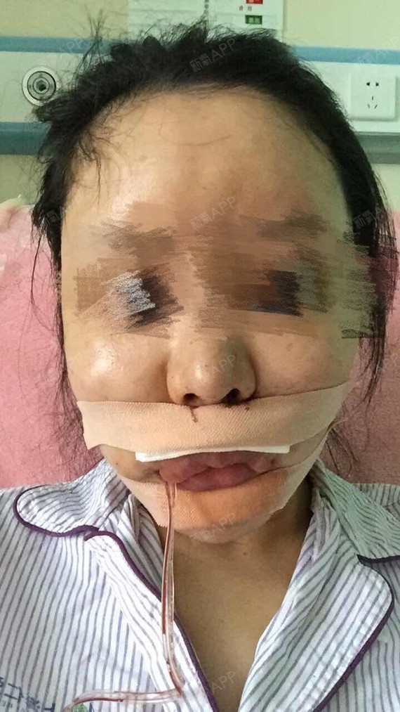 跳舞骷髅上下颚手术/突嘴矫正第2天美丽日记