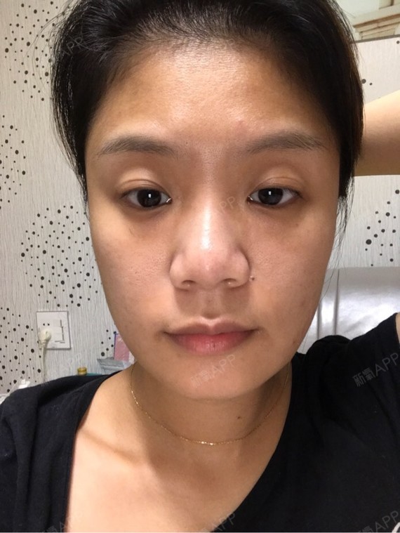 我打过瘦脸针,可是就是u型脸,很喜欢那些童颜脸,现_圈子-新氧美容整形