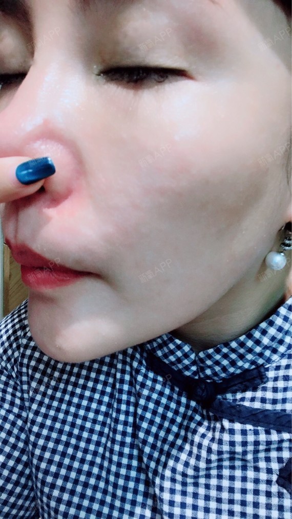 鼻翼两侧有明显的红血丝,总觉得有碍观瞻,听说dpl_圈子-新氧美容整形