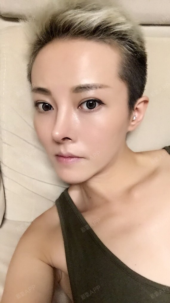 肋软骨隆鼻尖术后很快六个月了,这家医院确实是做这种_圈子-新氧美容