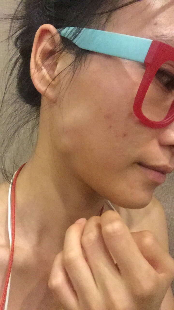 四川华美紫馨医学美容医院溶脂针瘦脸怎么样?