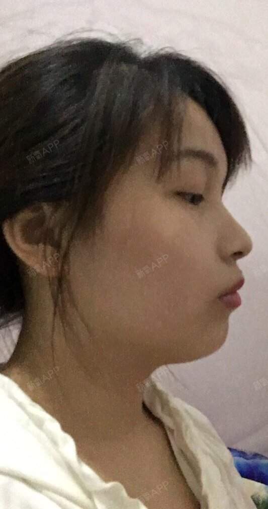 凸嘴且没山根,鼻子下巴额头人中都属于很短的那种,丑_圈子-新氧美容