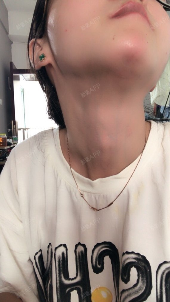 最近发现一个问题下巴有一个凹陷的地方不知道是垫的问_圈子-新氧美容