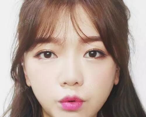 "下睑下至",这个名称起源于日本,手术全名叫下眼睑下至术,术后眼球