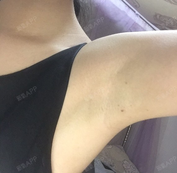 氧气3459971495702615 激光脱毛 术后当自强 深圳同城 脱腋毛