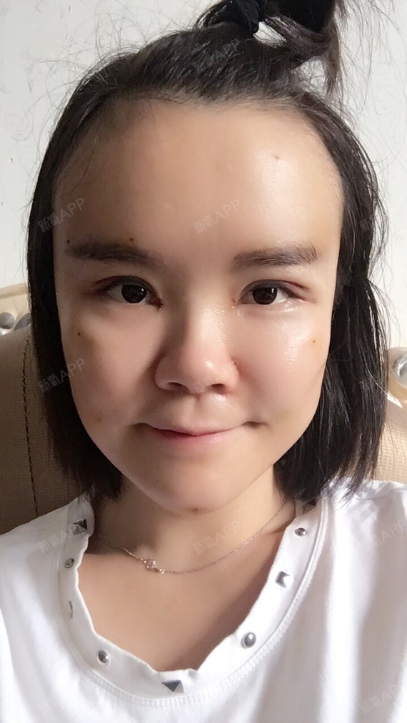 脂肪填充额头 | 自体脂肪填充太阳穴 | 自体脂肪填充法令纹 | 微整形