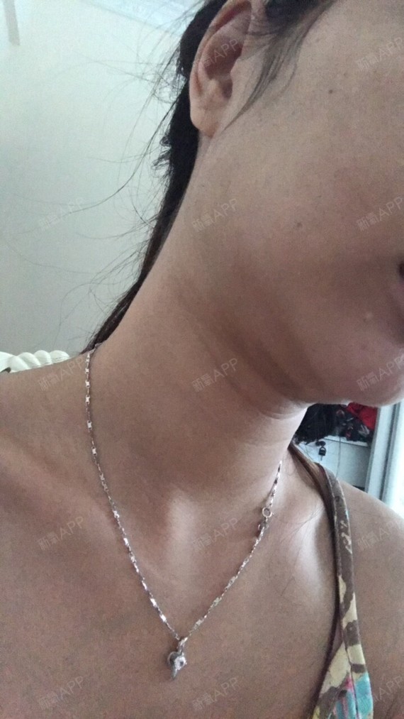 很久没来更新了,下巴下面还是有点肿肿痛痛的,近几天_圈子-新氧美容