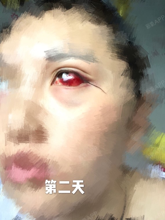 很难受 闭眼睁眼都很难受 外眼角看东西转眼球的时候 会痛 好烦哦