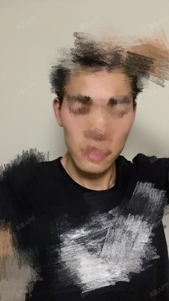 我是下颚骨两边不对称,导致脸部有大小脸,我本来就是长脸,导致我下巴